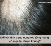 Đối với tình trạng rụng tóc từng mảng có mọc lại được không?