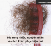 Tóc rụng nhiều nguyên nhân và cách khắc phục hiệu quả