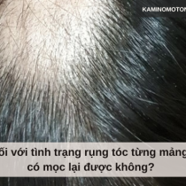 Đối với tình trạng rụng tóc từng mảng có mọc lại được không?