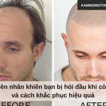 Nguyên nhân khiến bạn bị hói đầu khi còn trẻ và cách khắc phục hiệu quả