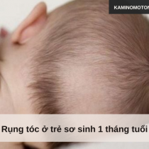 Rụng tóc ở trẻ sơ sinh 1 tháng tuổi