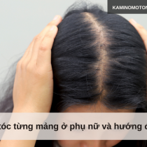 Rụng tóc từng mảng ở phụ nữ và hướng điều trị
