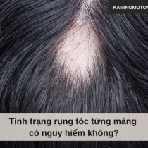 Tình trạng rụng tóc từng mảng có nguy hiểm không?