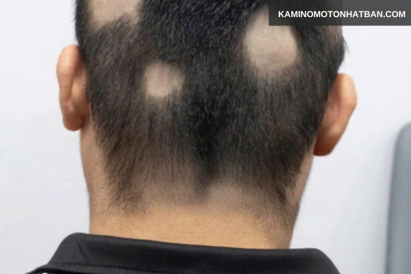 Đối với tình trạng rụng tóc từng mảng 