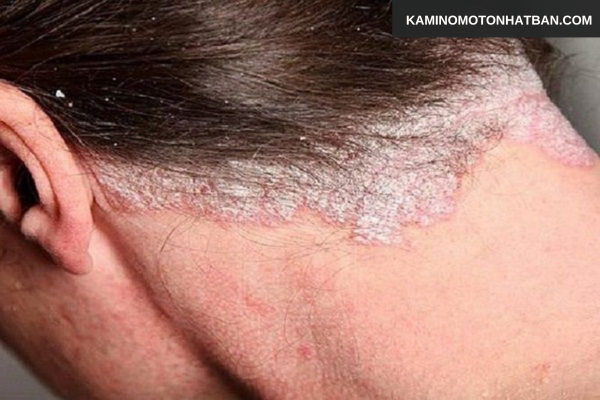 Các bệnh lý da đầu