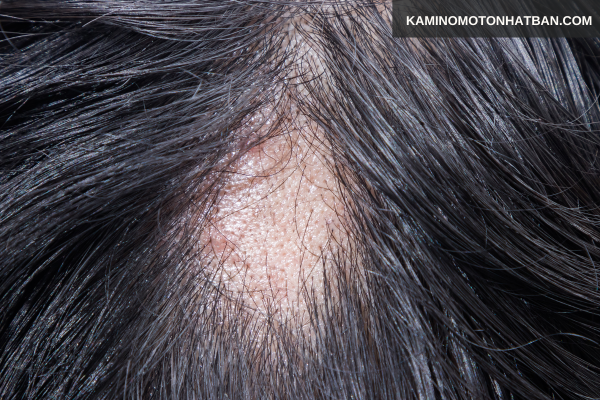 Một vài nguyên nhân gây rụng tóc từng mảng ở phụ nữ