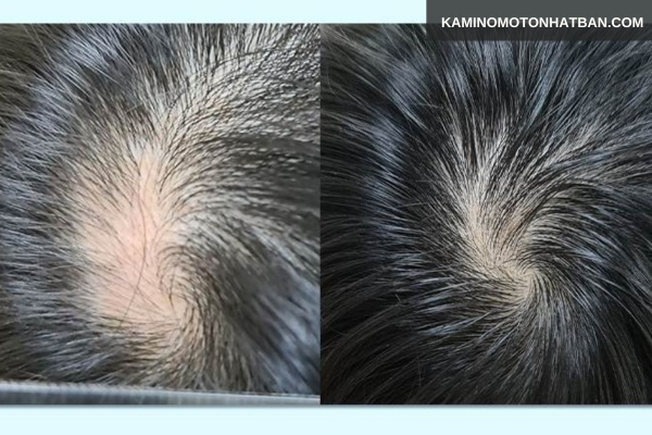 Một vài phương pháp điều trị rụng tóc từng mảng