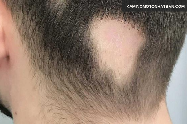 Rụng tóc từng mảng là gì?